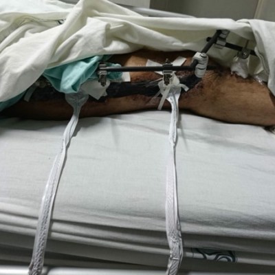 AMPUTACIÓN TRAS FRACTURA DESTAPA PRESUNTA NEGLIGENCIA MÉDICA EN HOSPITAL&nbsp;MORELOS